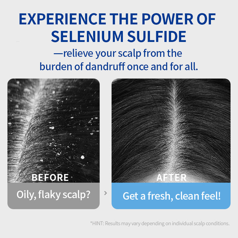 Selenium Sulfide Anti-Dandruff Shampoo | ZXUNASMR – Clears Dandruff, Soothes Itchy Scalp, Controls Oil & Adds Volume