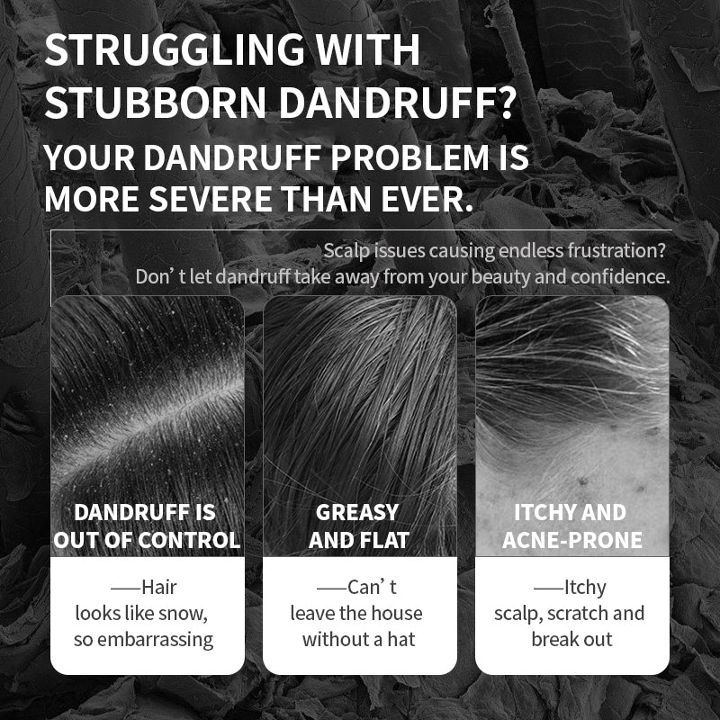 Selenium Sulfide Anti-Dandruff Shampoo | ZXUNASMR – Clears Dandruff, Soothes Itchy Scalp, Controls Oil & Adds Volume